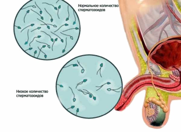 Фото: Спермограмма после свинки
